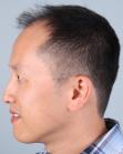 Before Hair Transplant&nbsp;Front